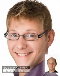 Men's Non-Surgical Hair Replacement at Hair Replacement Center of Iowa featuring OnRite from HairVisions International Men's Non-Surgical Hair Replacement Solutions from Hair Replacement Center of Iowa