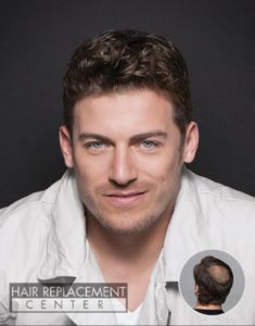 Men's Non-Surgical Hair Replacement at Hair Replacement Center of Iowa featuring OnRite from HairVisions International Men's Non-Surgical Hair Replacement Solutions from Hair Replacement Center of Iowa