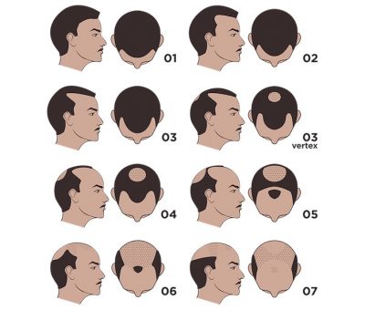 Norwood Hair Loss Scale - Hair Replacement Center of Iowa