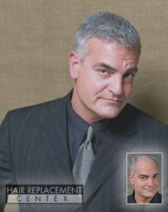 Men's Non-Surgical Hair Replacement at Hair Replacement Center of Iowa featuring OnRite from HairVisions International Men's Non-Surgical Hair Replacement Solutions from Hair Replacement Center of Iowa
