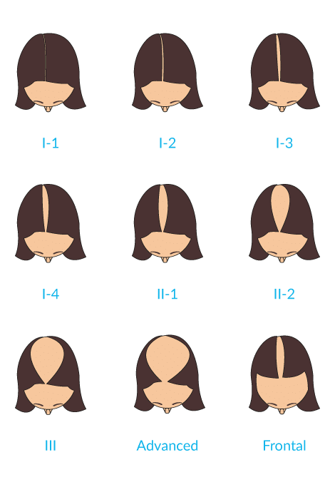 Ludwig Hair Loss Scale for Women