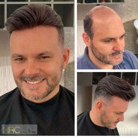 Before and After of Men's Non-Surgical Hair Replacement Embrace Confidence: The Importance of Men's Hair Replacement with HRC of Iowa