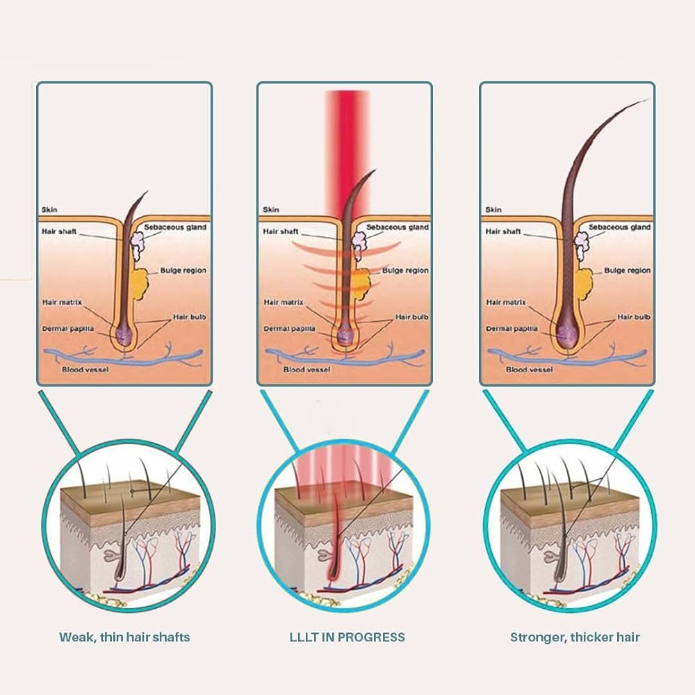 How low level laser light therapy grows hair