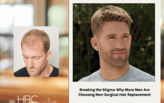 Men's Hair Loss - Non-Surgical Hair Replacement